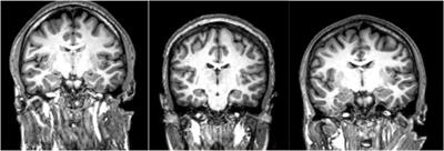 Frontiers | Neuroimaging In Schizophrenia: A Review Article